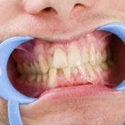 Estrazione denti per sovraffollamento
